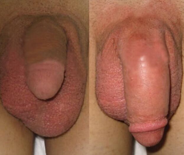 Натиҷаи насби матритсаи коллаген дар penis