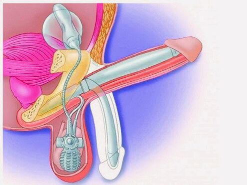 Васеъ кардани узв тавассути протези penis
